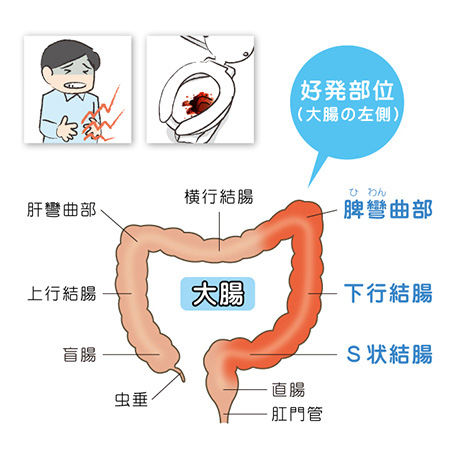 図：潰瘍性大腸炎の特徴